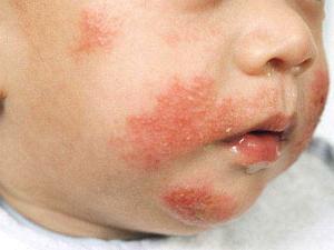 аллергия на лице