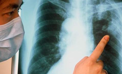 как определить туберкулез легких