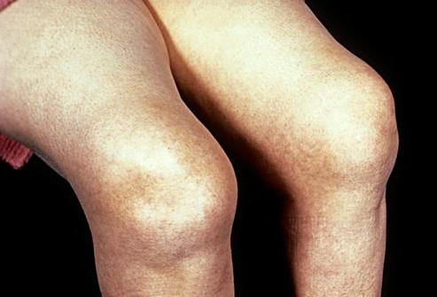 как лечить артрит коленного сустава 
