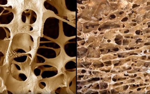 профилактика остеопороза