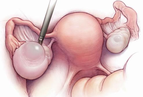 Киста яичника противопоказания