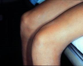 Растяжение связок коленного сустава симптомы