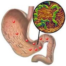 хронический дуоденит лечение