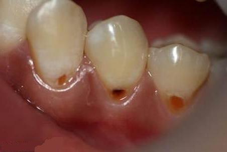 клиновидные дефекты зубов