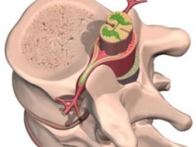 Стеноз позвоночного канала