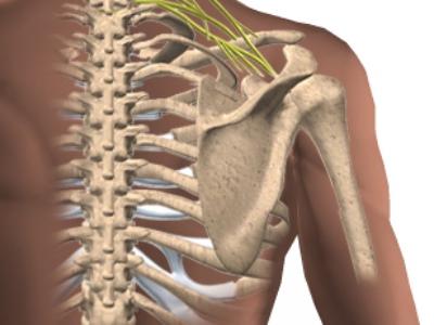 Защемление нерва под лопаткой
