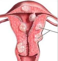 миома матки малых размеров 
