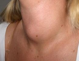 гиперплазия щитовидной железы