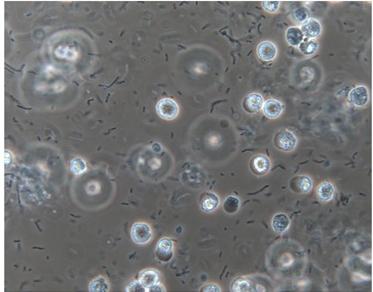 лейкоциты в моче у детей