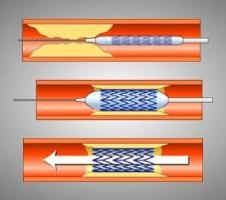 Стентирование сосудов сердца что это такое