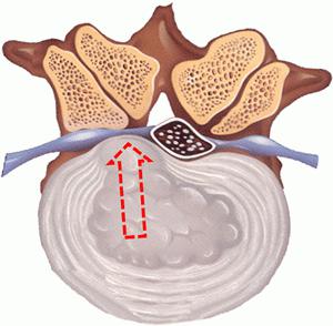 межпозвоночная грыжа поясничного отдела лечение