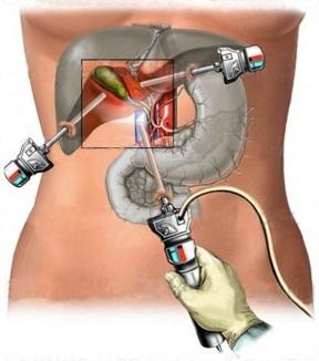 Последствия лапароскопии
