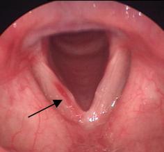 Голосовые связки. Лечение 