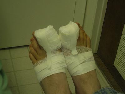 панариций пальца ноги лечение 