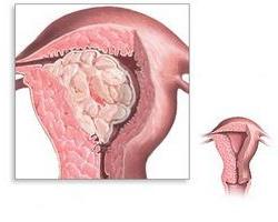 железисто кистозная гиперплазия эндометрия