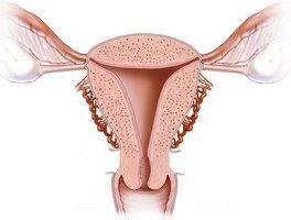 железисто кистозная гиперплазия эндометрия лечение