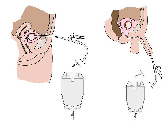 проведение катетеризации мочевого пузыря