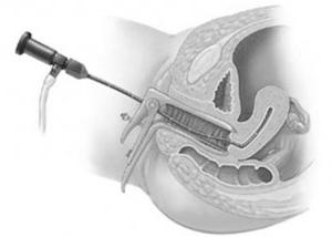  гистероскопия диагностическая