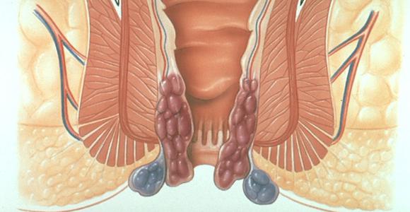 Как лечить геморрой в домашних условиях