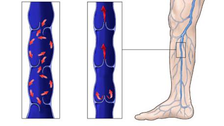 хроническая венозная недостаточность 