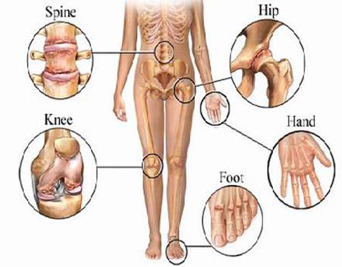что такое артроз коленного сустава 