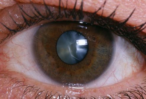 катаракта глаза после операции