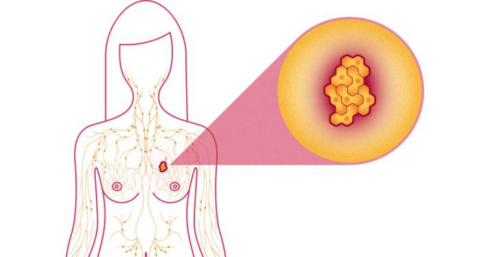фиброзно кистозная мастопатия лечение