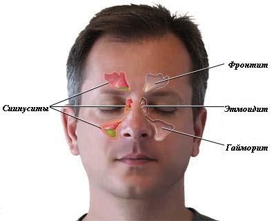 фронтит лечение 