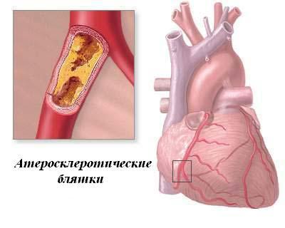 холестерин в крови норма