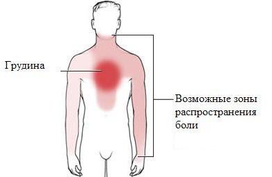 первые признаки стенокардии