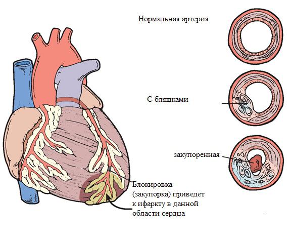 признаки стенокардии и ишемии