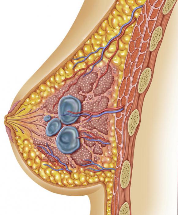 киста в груди 