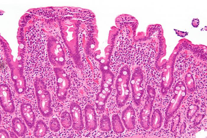 целиакия симптомы 
