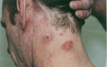 стафилококковая инфекция кожи лечение 