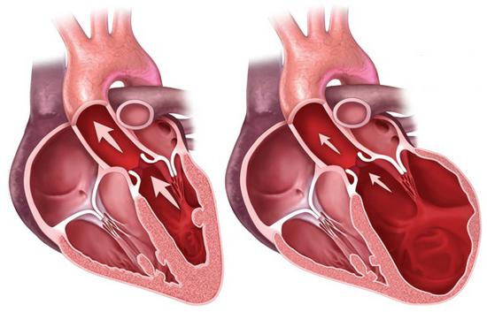 гипертрофическая кадиомиопатия