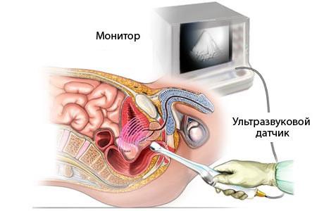 узи малого таза подготовка 