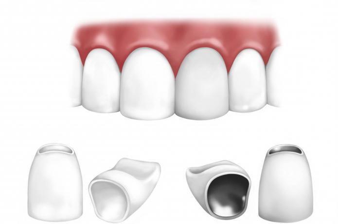 коронки на передние зубы