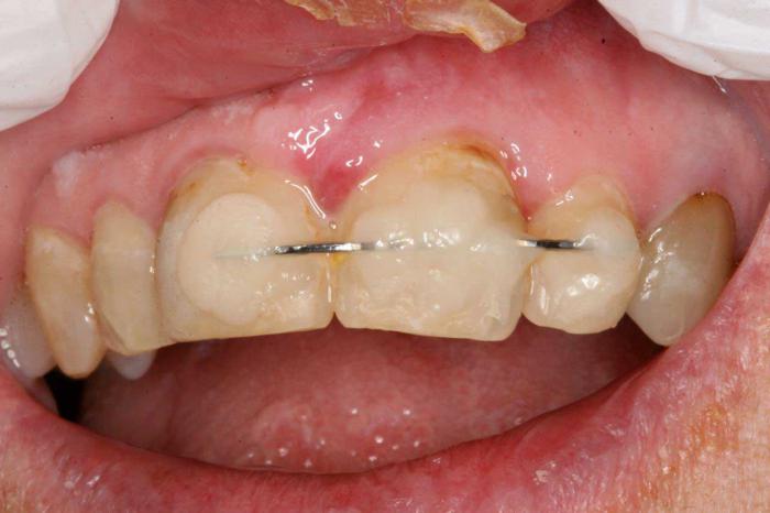 шинирование зубов при парадонтозе
