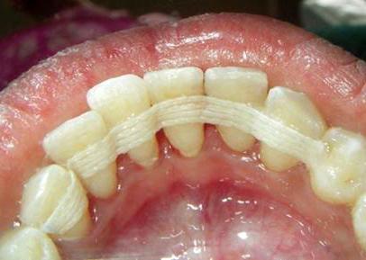 шинирование зубов при пародонтозе отзывы