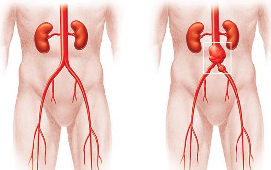атеросклероз брюшной аорты симптомы