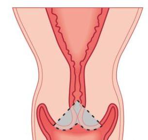 короткая шейка матки при беременности лечение