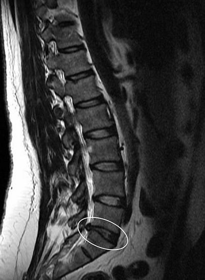 протрузия межпозвоночного диска