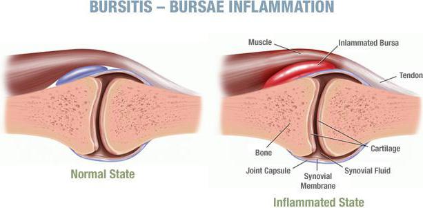 лечение бурсита