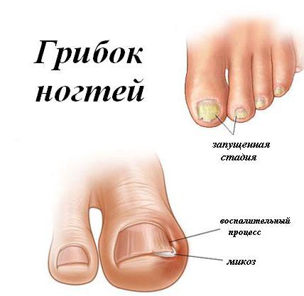 симптом грибка стоп и ногтей 
