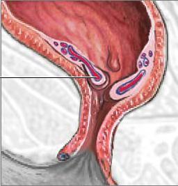  зуд в анальном отверстии