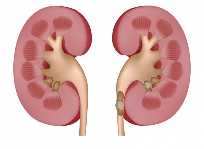 Диета при камнях в почках