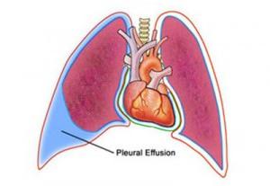 экссудативный плеврит
