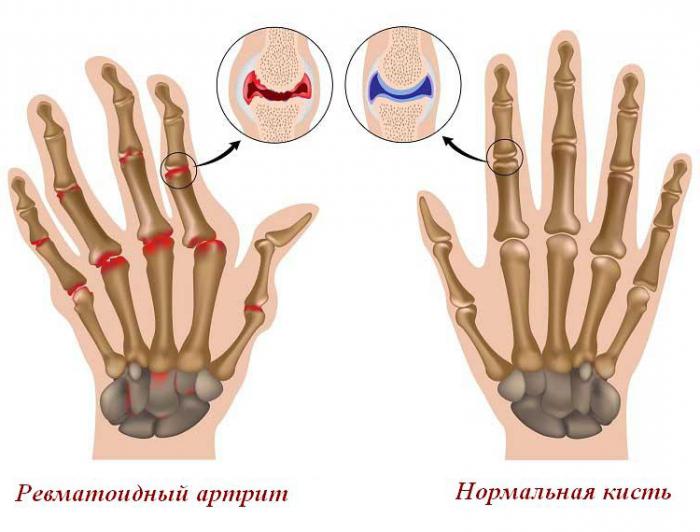 как лечить артрит