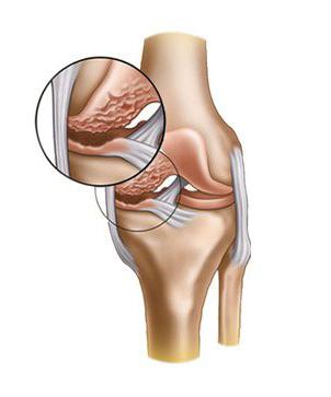 Степени артроза коленного сустава