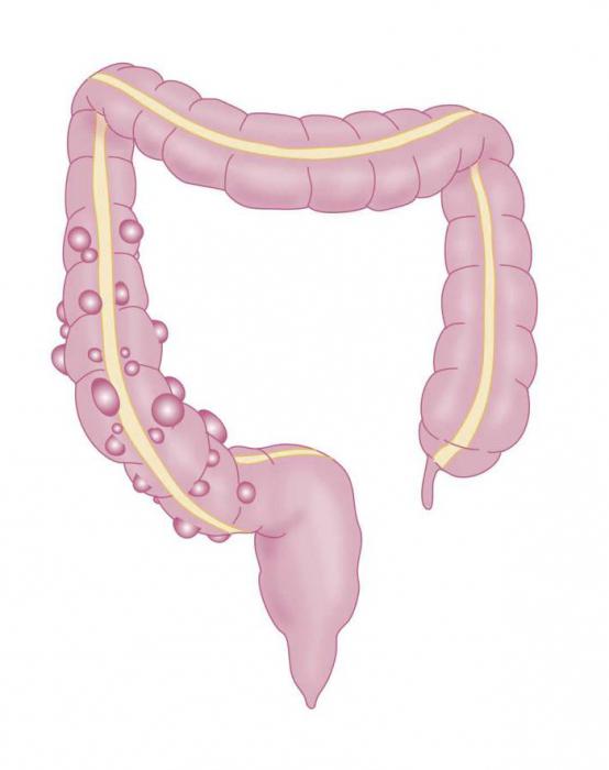 дивертикулез толстой кишки причины